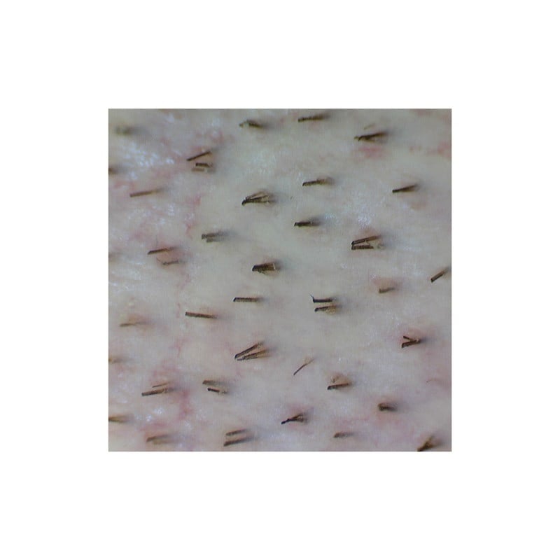 Firefly Video Dermatoscope DE350 (wireless data transfer)