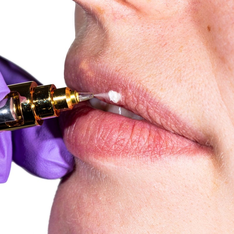 Cryoalfa SUPER Liquid | in blister