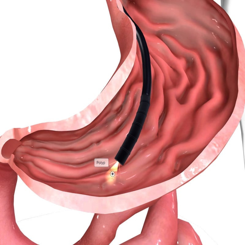 HD-500 Video Gastroscope EG-500L